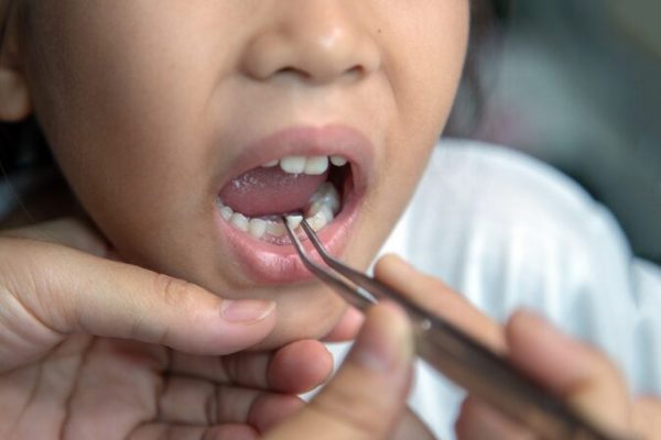 Kids Dental Care
