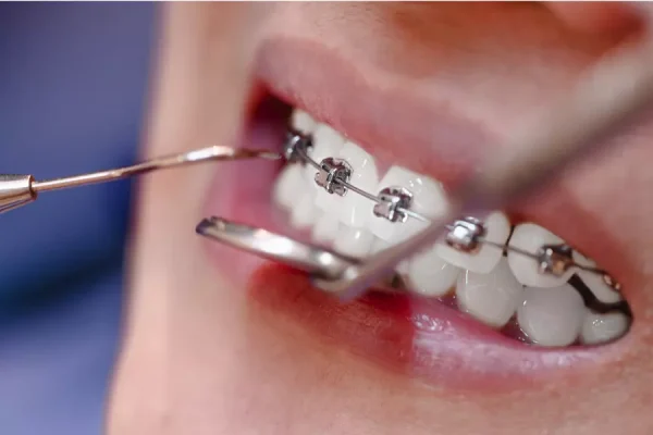 Braces & Clear Aligners